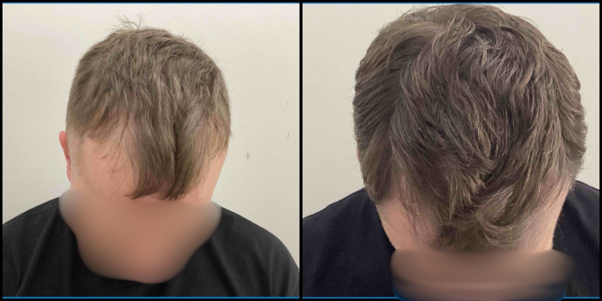 Before and after hair restoration result 1
