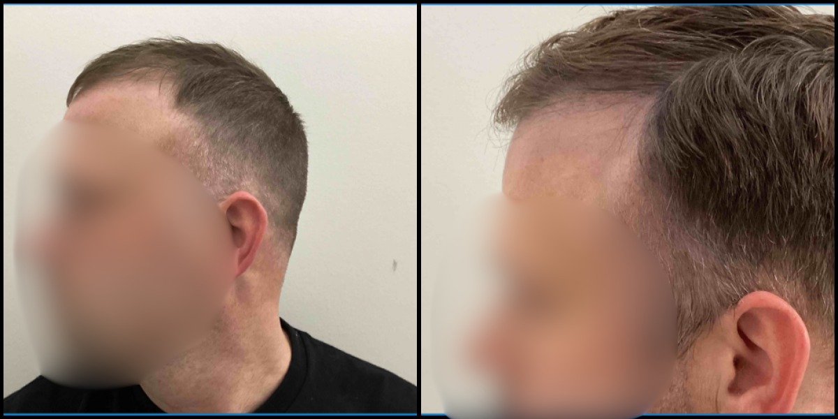 Before and after hair restoration result 2